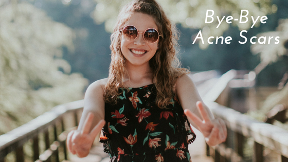 Say Bye-Bye to Acne Scars Naturally